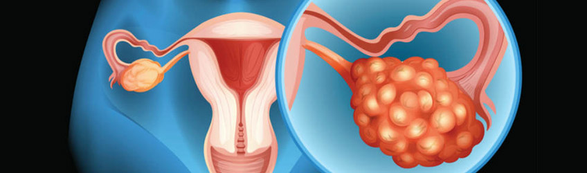 Cáncer de Ovario
