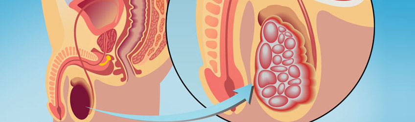 Que es el tumor testicular.