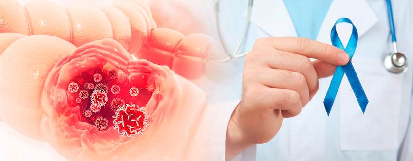Cáncer de Colon,  Una enfermedad evasiva
